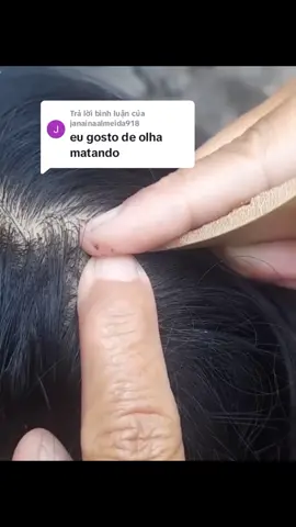 Trả lời @janainaalmeida918 Hope you relax with my videos!  thanks#viralvideo #fyp #tick #lice #foryou #viral #parasite #fypシ 