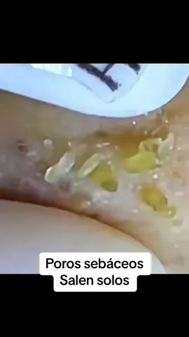 #Extracción #poros #granos#pelo #espinillas #limpiezafacial #acne #tratamientos 