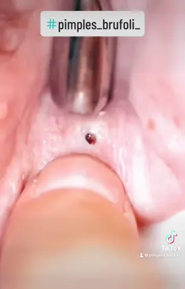 #cravos #brufoli #blackhead #zit #pimples_brufoli_ #popping #asmr #zits #pimples #granos #acne #popper #pimple #pimples_brufoli #granosyespinillas #pimplepop 