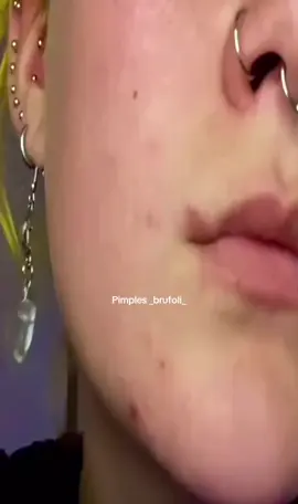 #cravos #brufoli #blackhead #zit #pimples_brufoli_ #popping #asmr #zits #pimples #granos #acne #popper #pimple #pimples_brufoli #granosyespinillas #pimplepop 