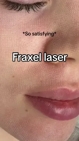 Just got Fraxel laser done for the first time at @Anaderm_ . Fraxel laser is a skin treatment using precise laser beams to improve texture and tone. It helps with wrinkles, scars, and pigmentation. It's a quick procedure with minimal downtime. #FraxelLaser #SkinCare ##skinrejuvenation #skinlasertreatment #antiaging 