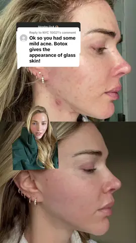 Replying to @NYC 10021 16 months of consistent skincare! My acne cleared up in the first 4 months  