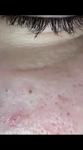 #cravos #brufoli #blackhead #zit #pimples_brufoli_ #popping #asmr #zits #pimples #granos #acne #popper #pimple #pimples_brufoli #pimplepop #granosyespinillas 