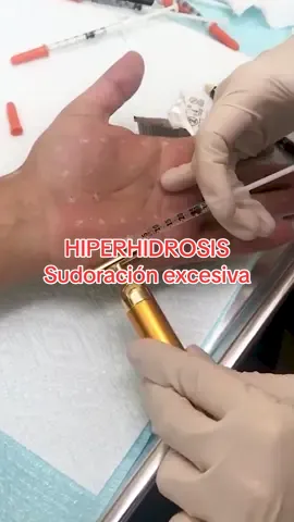 ¿Tienes sudoración excesiva en axilas, manos o pies? 🥹#Botox es la solución!! #viraltiktok #facial #sudoracion #hiperhidrosis #axilas 
