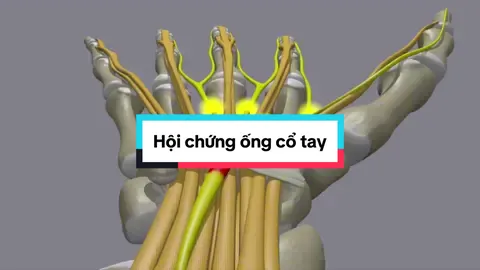 Mô phỏng hội chứng ống cổ tay #bacsithoan #suckhoe #hoichungongcotay #tiktok 