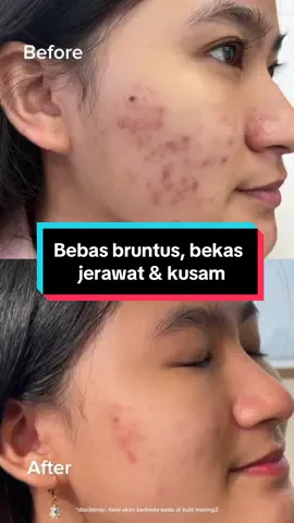 Beli skincare berjibun-jibun ❌ Beli skincare satu aja ✅ #fyp #viral #jerawat #bekasjerawat #kusam #creammask 