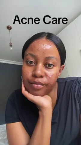 I accept the flaws in myself. They let me love who I am more. One way I show myself love is through my self-care regimen.  In what ways do you show yourself love? #SAMA28 #acnepositivity #fyp #explore #blackgirlswithacne #foryoupagе #acneproneskincare #hormonalacne 