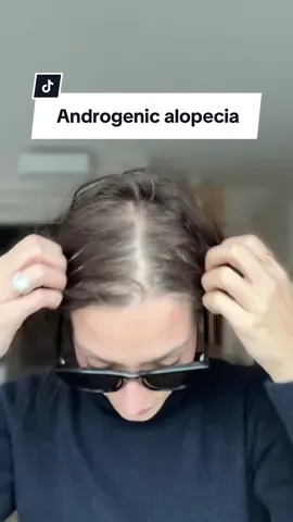 50% of women will experience hair loss. You’re not alone ❤️  #hairloss #femalepatternhairloss #androgenicalopecia #femalehairloss 