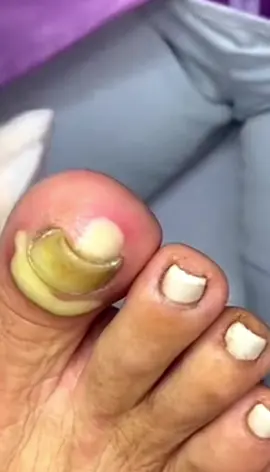 Desinfeccion dn el dedo gordo del pie #granosyespinillas #viral #satisfyingvideo #satisfaction #satisfying #fyp #pimplepop #pimple #filamentossebaceos #acne #puntosnegros #granos #parati #CleanTok #limpiezafacial #foryou 