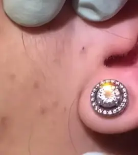 #cravos #brufoli #blackhead #zit #pimples_brufoli_ #popping #zits #asmr #pimples #granos #acne #popper #pimple #pimples_brufoli #granosyespinillas #pimplepop 
