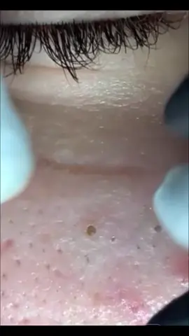 #cravos #brufoli #blackhead #zit #pimples_brufoli_ #popping #zits #asmr #pimples #granos #acne #popper #pimple #pimples_brufoli #granosyespinillas #pimplepop 