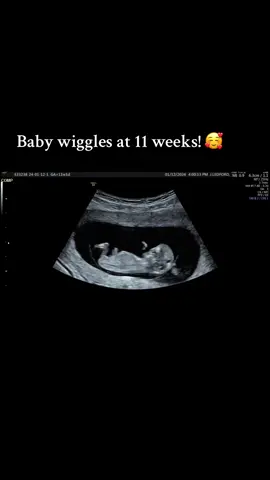 Adorable 11-week-old baby steals the show with heartwarming wiggles during our session!  👶💕 #BabyLove #ultrasoundmagic #wintergardenflorida #ocoeefl #winderemere #clermontflorida #ultrasound #sonographer #3dultrasound #5dultrasound #4dultrasound #3d4dultrasound #mom2be #momtobe #mommytobe #mom #expecting #babyontheway #babyonboard #baby #pregnancy #pregnant #pregnancyannouncement #ultrasoundtech  #foryou #bunintheoven 