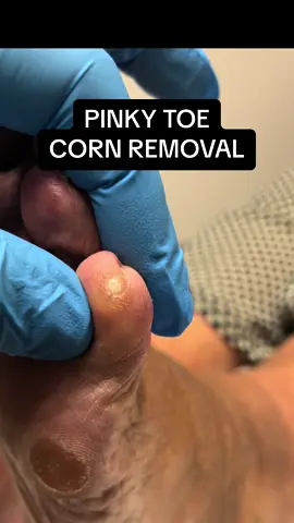 This corn developed on the pinky toe due to pressure from narrow footwear. #fyp #foryou #foryoupage #viral #sydney #australia #podiatry #feet #foot #satisfying #cornremoval #corn #pimple 
