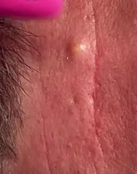 #Isegretidellapelleperfetta #cravos #Suggerimentiperlenirel #brufoli #blackhead #zit #asmr #popping #pimples_brufoli_ #zits #pimples #granos #acne #popper #pimple #granosyespinillas #pimplepop #pimples_brufoli 