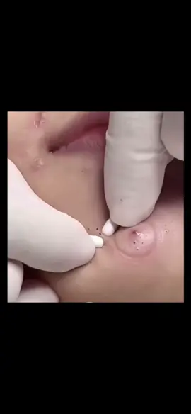 #Isegretidellapelleperfetta #cravos #Suggerimentiperlenirel #brufoli #blackhead #zit #asmr #popping #pimples_brufoli_ #zits #pimples #granos #acne #popper #pimple #granosyespinillas #pimplepop #pimples_brufoli 