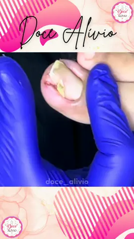 #podologia #podologa #podolog #unhas #pedicure #podologiacomamor #manicure #saude #nails #pes #podology #saudedospes #unhaencravada #pies #foot #satisfatorio #tiktokviral #fyp #saúde 