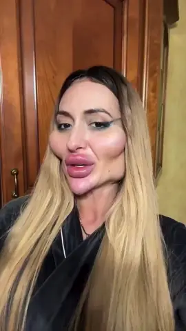 Estetikle dünyanın en büyük elmacık kemikli yanaklarına sahip olan Ukraynalı model Anastasia Pokreshchuk, hakkında yapılan yorumlara güldüğünü söyledi ve ekledi: Beni kıskanıyorlar!#estetik #elmacikkemigi #magazinhaberleri 