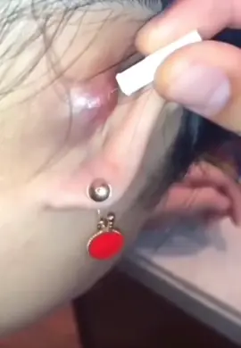 #Isegretidellapelleperfetta #cravos #Suggerimentiperlenirel #brufoli #blackhead #zit #asmr #popping #pimples_brufoli_ #zits #pimples #granos #acne #popper #pimple #granosyespinillas #pimplepop #pimples_brufoli 