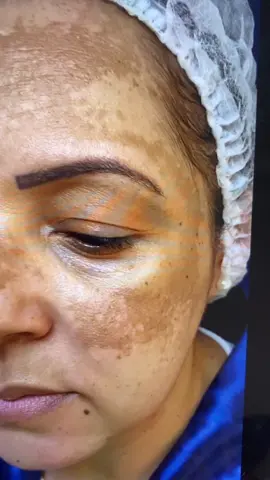 Livre de Melasma!  Você também pode manter seu melasma controlado! Sme promessas milagrosas, apenas o tratamento adequado e individualizado!  Agende sua avaliação! #melasma #melasmatratamento #pele #cuidado 