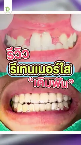 ฟันหลอก็จัดฟันได้นะ 😍 รีวิวรีเทนเนอร์ใสเติมฟันให้กลับมายิ้มสวยอีกครั้ง 👍🦷 #ฟันหลอ  #ฟันหลอจัดฟัน  #รีเทนเนอร์  #รีเทนเนอร์ใส  #รีเทนเนอร์ฟันปลอม  #จัดฟัน  #รีเทนเนอร์เติมฟัน  #ฟันหลอแต่หมอดี  #จัดฟันเมล่อน  #คลินิกทันตกรรมเมล่อน  #melondentalclinic