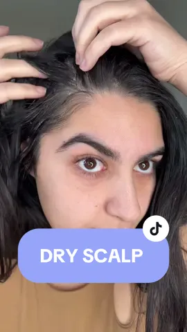Lately ive been experiencing dry scalp, dandruff and im not sure if its the winter season but this has been happening. I wash hair once a week- #dryscalp #dandruff #dryscalphack #dryhair #hair #straighthair 