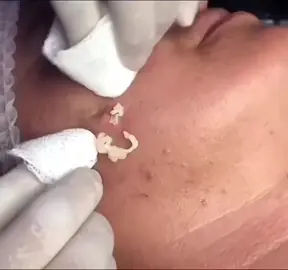 #Isegretidellapelleperfetta #cravos #Suggerimentiperlenirel #brufoli #blackhead #zit #asmr #popping #pimples_brufoli_ #zits #pimples #granos #acne #popper #pimple #granosyespinillas #pimplepop #pimples_brufoli 