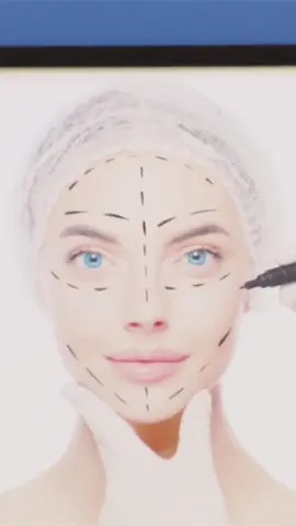 Botox Prank #botox #prank 