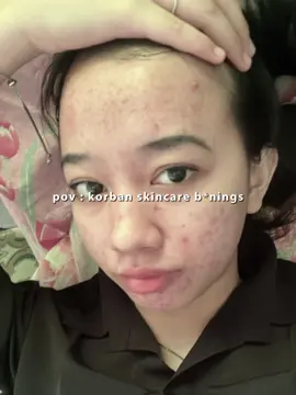 iseng nyoba bbrp hari doang pas dilepas tetap keluar terus jerawatnya sampe parah tp alhamdulilah sekarang ilang si tpi trauma bgt sm itu huhu #korbanskincare #acnefighter #fyp 