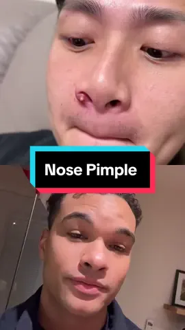 #duet with @Felina Ive never had a pimple on that area if my nose but jusdging by the swelling and inflamation its more than likely uncomfortable #mrpopalot 