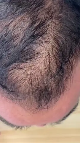 Com a Maquiagem Capilar SEVICH você esconde suas falhas capilares em segundos! Além disso, o SEVICH: • Cobre os fios brancos • Preenche todas as falhas! • 100% natural e prático! • É a prova d’agua e suor! Adquira a sua com Desconto válido somete hoje! #calvice #alopeciaandrogenetica #belavital