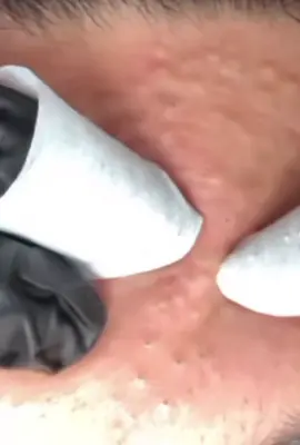 #Isegretidellapelleperfetta #cravos #Suggerimentiperlenirel #brufoli #blackhead #zit #asmr #popping #pimples_brufoli_ #zits #pimples #granos #acne #popper #pimple #granosyespinillas #pimplepop #pimples_brufoli 