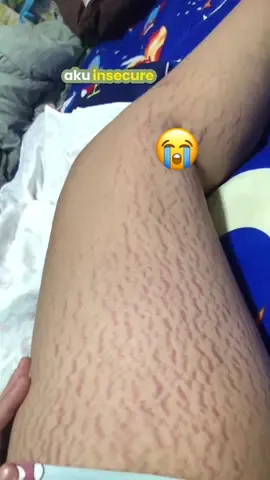 Demi apapun aku insecure banget karena stretchmarks membandel, untungnya ada cream&serum pemudar stretchmarks dalam dua minggu, wajib CO sekarang sih 😍🥰 #stretchmarks #creamstretchmark #stretchmarkremoval #haibuna #bumil #busui #kulitmulus 