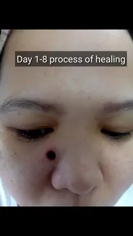 Maraming salamat sa kasoy cream 1 to 8 days lang natagkal na agad at nag mukhang malinis lalo ang mukha ko 😍💖 #naturesmiraclewartsremoval #kasoyoilwartsremover 🛒✨