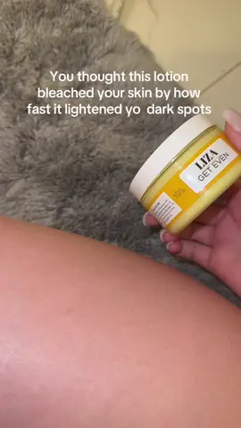 Like… my dark spots and scars are gone #darkspots #hyperpigmentation #acne #skincare #kojicacid #turmeric #lotion #hype 