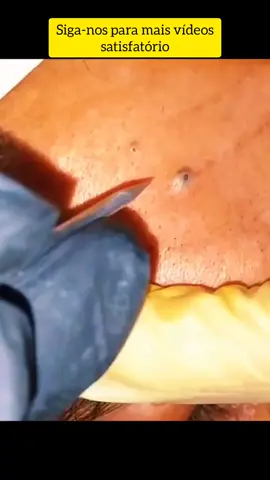 REMOÇÃO DE CRAVOS GIGANTE SATISFATÓRIO #ACNES #CRAVOS #REMOÇAODECRAVOS #CRAVOSGIGANTES #REMOÇAODECRAVOS #CRAVOS #ESPINHAS #GIGANTE #REMOÇAODECRAVOS #CRAVOSEESPINHAS 