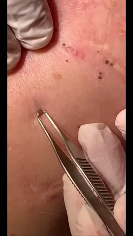 #extractions #pimples #blackhead #acne #ingrownhair #satisfying #blackheadsremoval #ingrownhairremoval #pimple #extraction #bouton #pointnoirs 