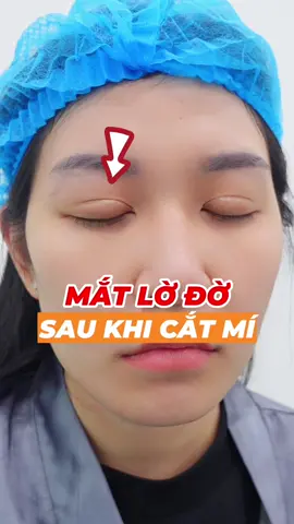 Mắt lờ đờ sau cắt mí #xuhuong #bacsithinhchuyencatmi  #bacsithinhdanang