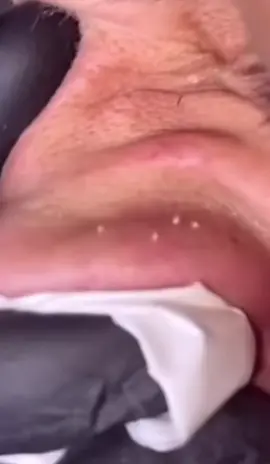 Woooow!! #granosyespinillas #viral #satisfyingvideo #satisfaction #satisfying #fyp #pimplepop #pimple #filamentossebaceos #acne #puntosnegros #granos #parati #CleanTok #limpiezafacial #foryou 