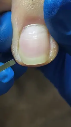 #nails #toenail #toenailremoval #ingrowntoenail #satisfyingvideo #foryourpage 