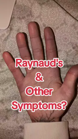 Feel free to message me if you have any questions. Stay safe and warm out there! #raynauds #severe #autoimmunedisease  #RCVS #coldhands #symptoms #unexplained #fever #fatigue 