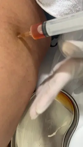 #CapCut  Remoção de seroma após  Lipoaspiração  #lipohd #lipospiracao #plastica 