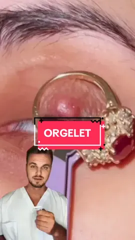 L’ORTHÉRAPIE #orgelet #eye #eyes #ophtalmologie #dermatologie #medecine #sante #apprendresurtiktok 