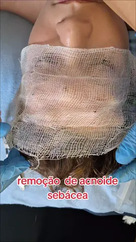 remoção de acnoide sebacea#pimple #satisfying #limpezafacial #extraçaodecravoseespinhas #viralvideo #tratamento #tiktok 