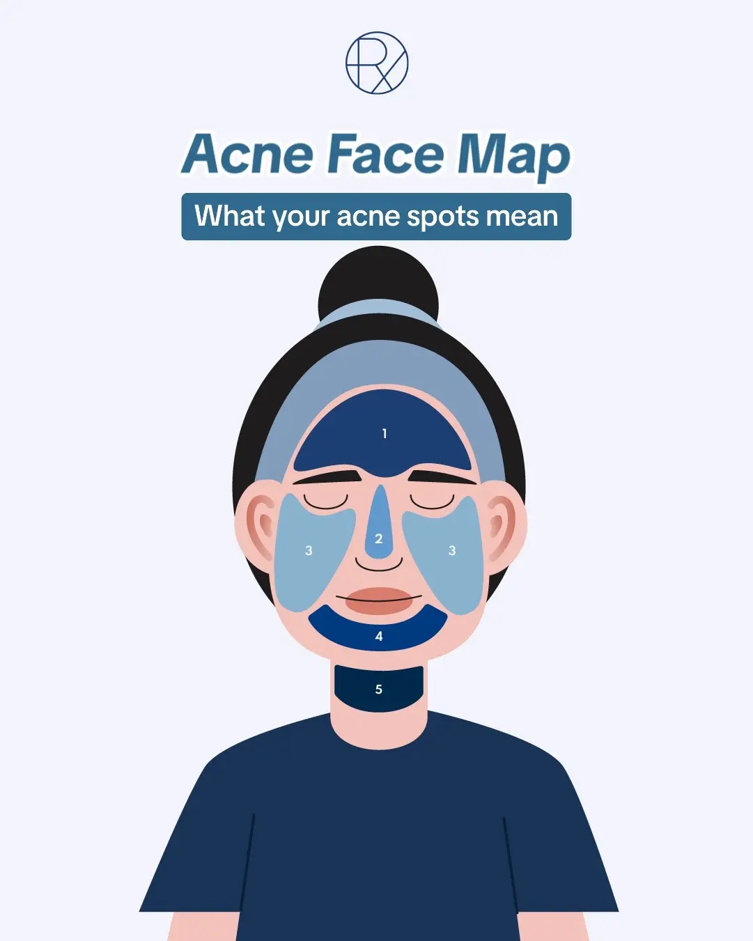 Breaking out may be normal but it can also be your body’s way of sending you signals that something may be off 🚨 Let’s decode your skin together! Send us a DM to book a skin analyzer session or doctor’s consultation 💌 #RemedySkinSolutions #acne #facemap #acnefacemap #breakouts #fypシ 