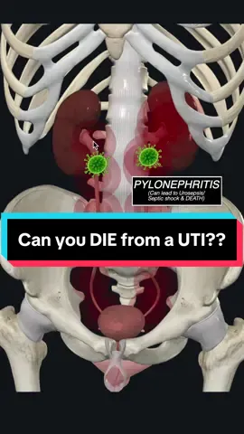 Can you DIE from a UTI?  #medspiration . . . #uti #urinarytractinfection #urinarytracthealth #urinalysis #urology #cystitis #urethra #pyelonephritis #anatomy #infection #sepsis #septicshock #pathology