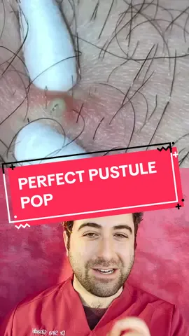 #duet with @Relax 365 #acne #pimplepop #pimpleremoval #pimplepopper #pimple #whiteheads #whiteheadremoval #whitehead #blackhead #cyst #blister 