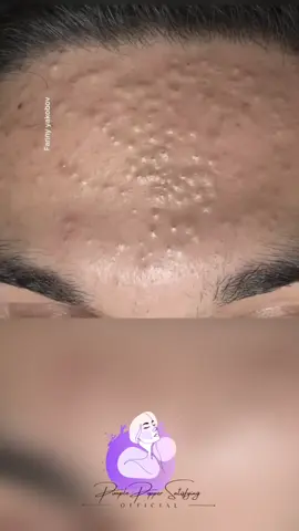 #pimplepoppersatisfying 