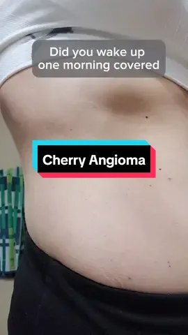 These little red moles are called cherry angiomas.  Keep reading to find out how it is  tied to Hashimotos, and how it isn't.  Share this with a friend who could use this information and give me a follow.  They are common, NON-cancerous skin growths that typically appear on arms, legs, and torsos in those over 30, they are made of blood vessels or lymphatic vessels.   I didn't have any on my body, and I woke up one day when I was 37 and was covered with them.    I went to my doctor, and he said, 