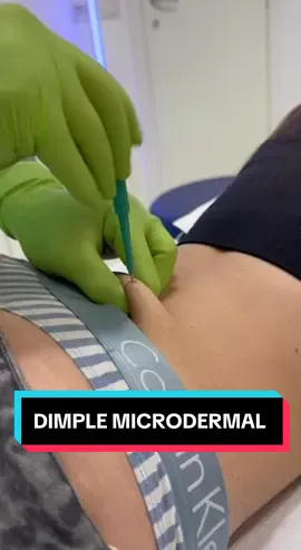 DIMPLE MICRODERMAL - Doypu prefer so near or more distance ? #microderma #dimplemicrodermal #microdermalpiercing #piercer #piercinglovers #piercing #dimitridaleno #jewels 