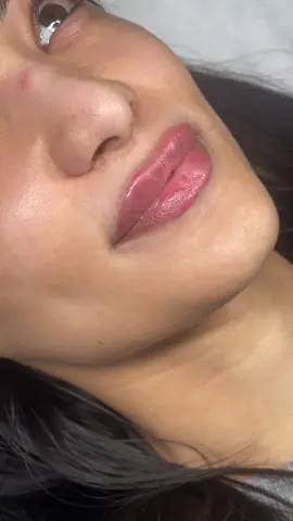 0,55ml lip filler 🥰🫦 #lipfiller #lips #fillers #lipsberlin #lipfillersberlin #lipfillerberlin #hyaluron #hyaluronicacid #lipsforkiss #beautifullips #lipinjection #injection #fillercheck #juvederm #juvedermlips 